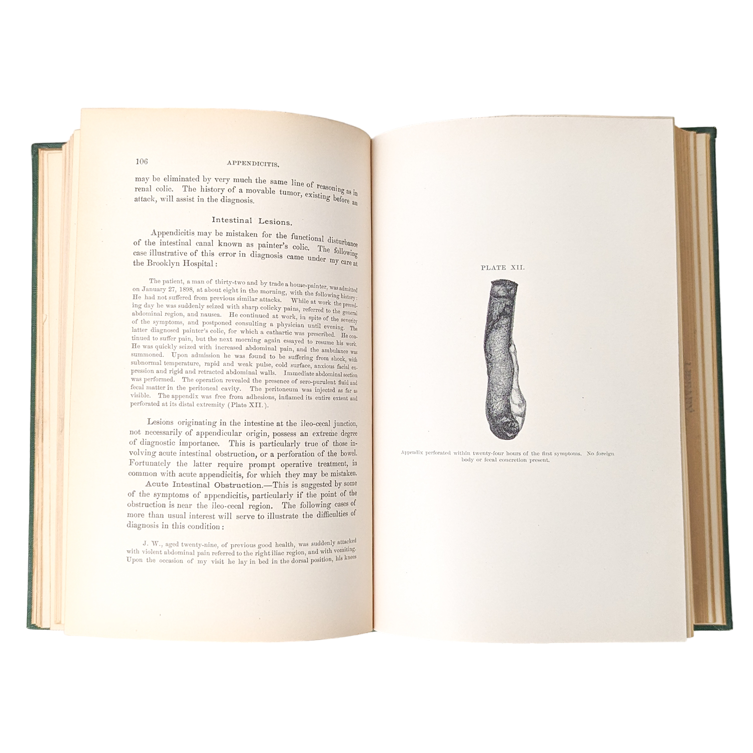 Antique 1902 Medical Book: A Treatise on Appendicitis