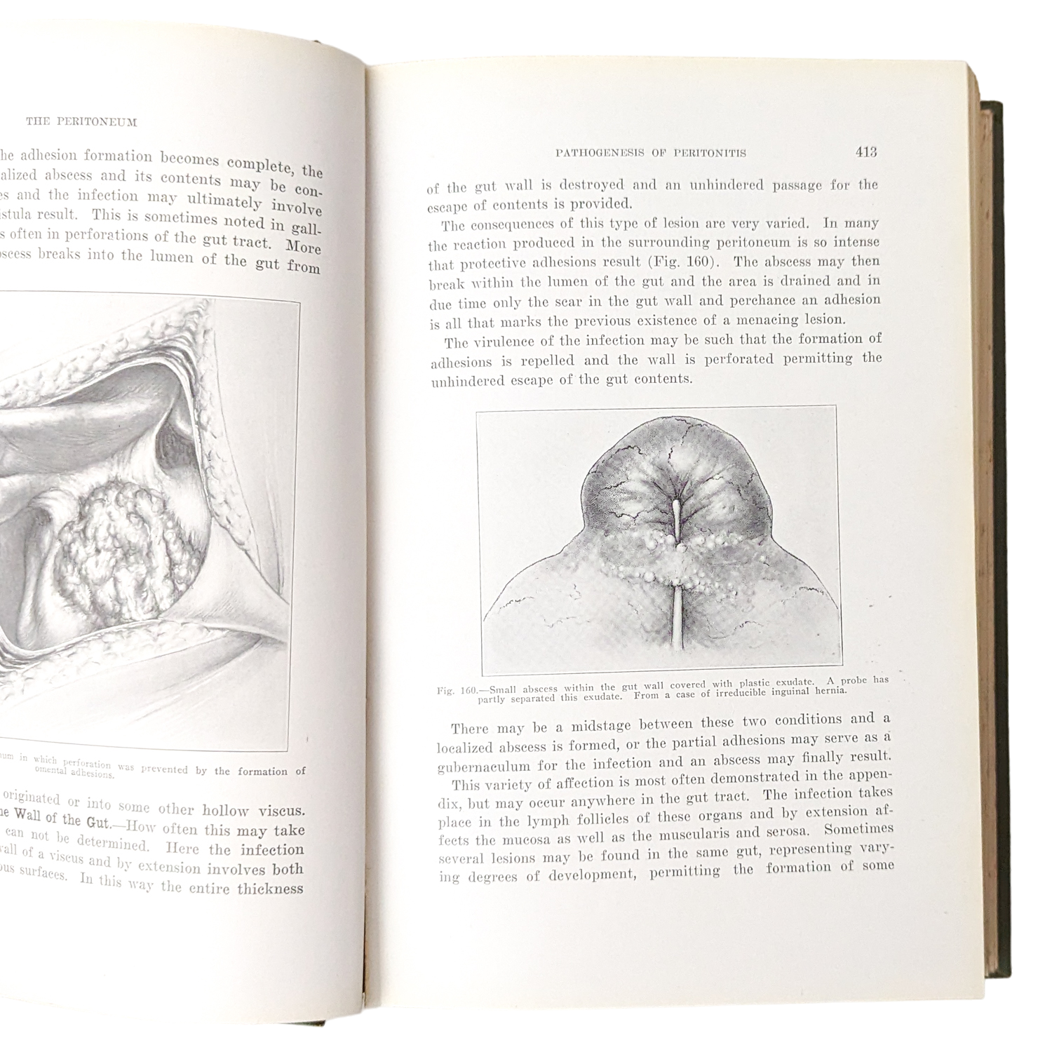 Antique 1919 Medical Book: The Peritoneum