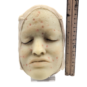 Antique Moulage Wax Pathology Model Face