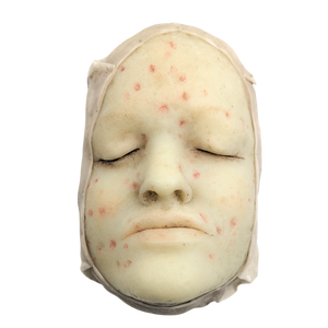 Antique Moulage Wax Pathology Model Face