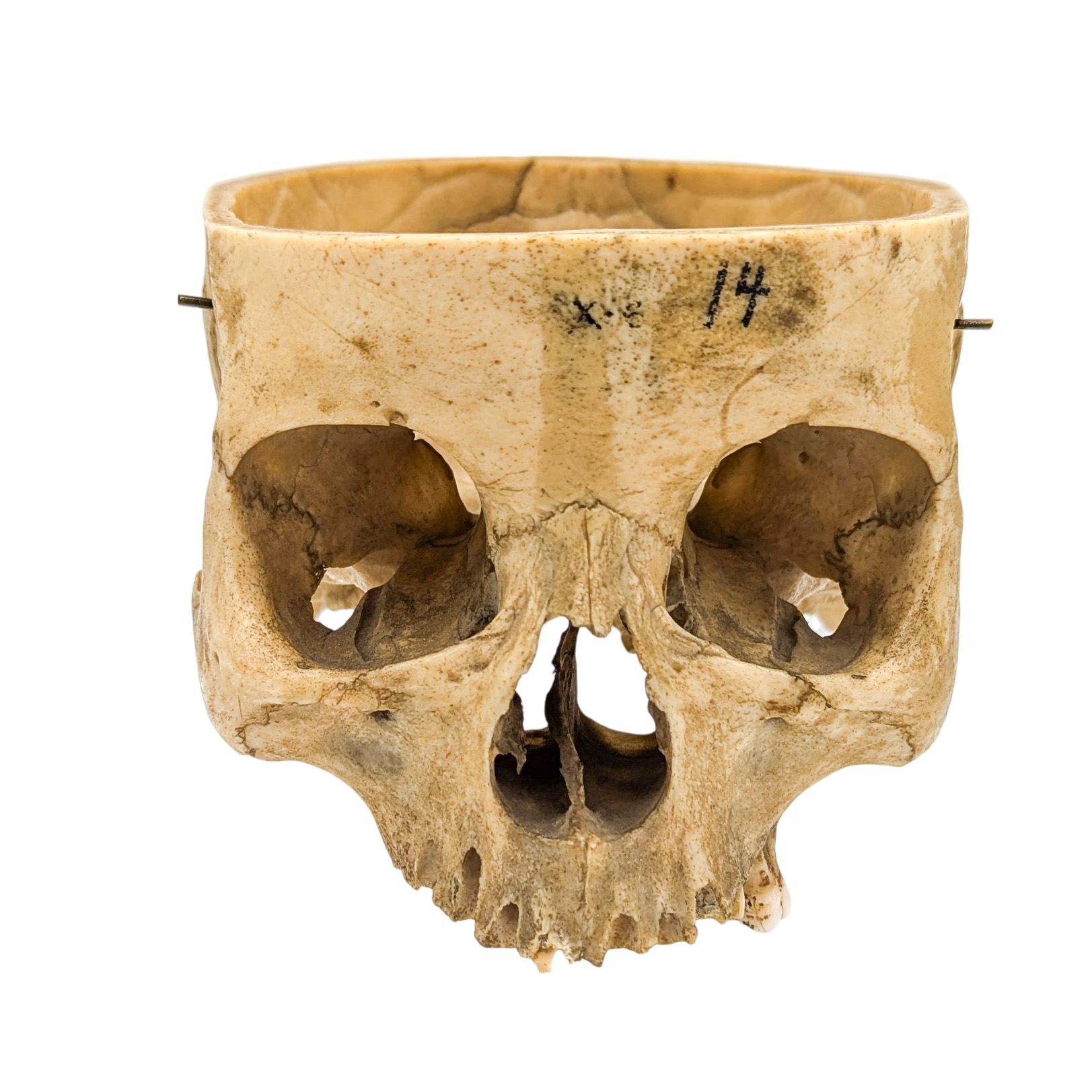 Real Partial Human Skull