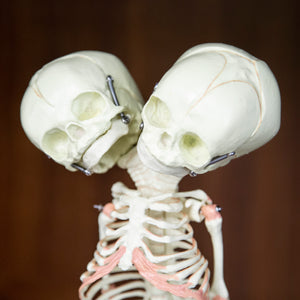 Conjoined Fetal Twin Anatomical Model